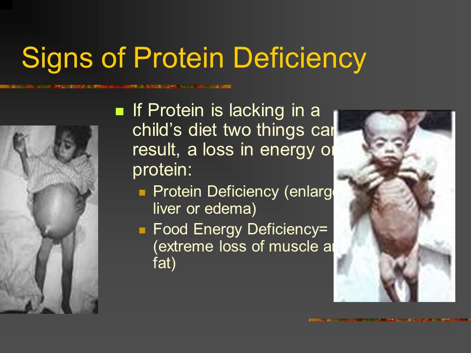 Protein deficiency symptoms